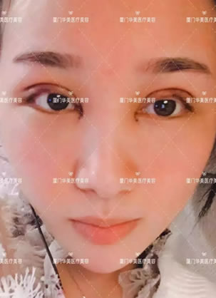 35天双眼皮成功经历证明选择厦门华美陈运生做翘睫美瞳术没错