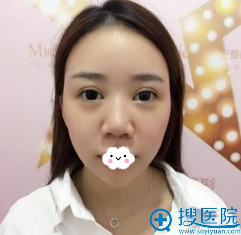 武汉美天朱晓浩为我做假体隆鼻+耳软骨垫鼻尖后男票说我美翻天