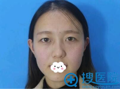 扬州雷岳崇医生双眼皮+开眼角案例 扬州雷岳崇医生双眼皮+开眼角案例