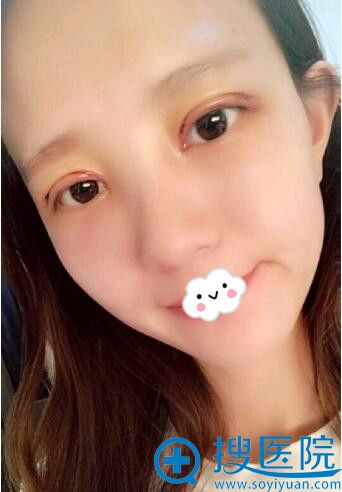 扬州雷岳崇双眼皮+开眼角案例 扬州雷岳崇双眼皮+开眼角案例