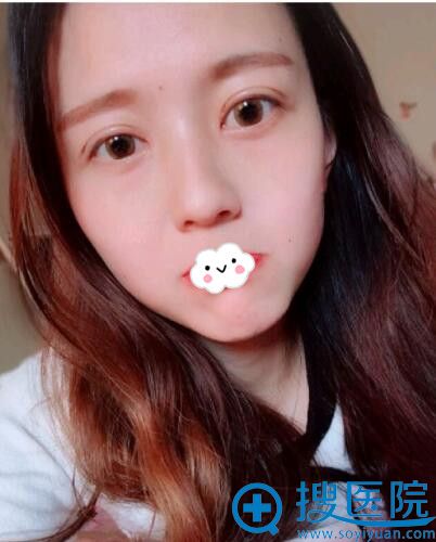 <!--<i data=20240710 data-id=9440></i>-->整形医院双眼皮真人案例 <!--<i data=20240710 data-id=9440></i>-->整形医院双眼皮真人案例
