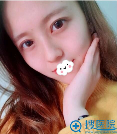 <!--<i data=20240710 data-id=9440></i>-->整形医院切开双眼皮+开眼角效果 <!--<i data=20240710 data-id=9440></i>-->整形医院切开双眼皮+开眼角效果