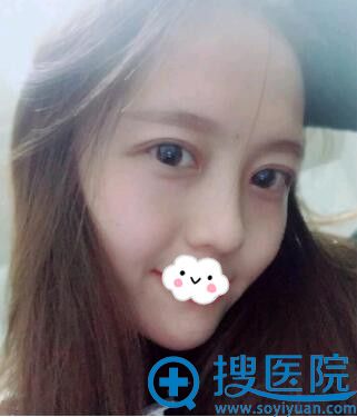 <!--<i data=20240710 data-id=9440></i>-->整形医院双眼皮案例 <!--<i data=20240710 data-id=9440></i>-->整形医院双眼皮案例