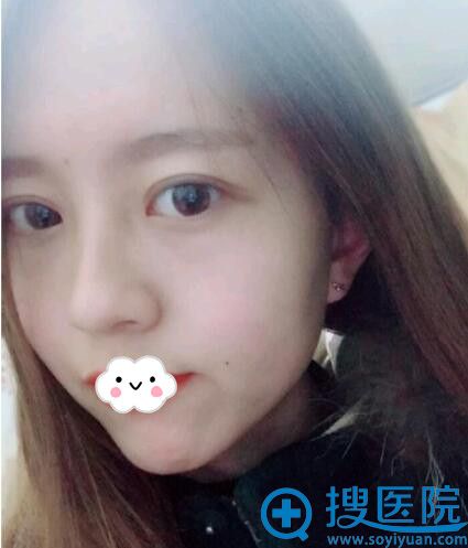 <!--<i data=20240710 data-id=9440></i>-->整形医院双眼皮+开眼角案例 <!--<i data=20240710 data-id=9440></i>-->整形医院双眼皮+开眼角案例