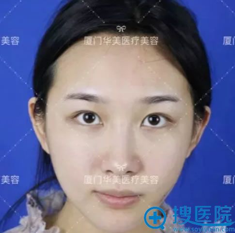 在华美做双眼皮手术前的内双照片 在华美做双眼皮手术前的内双照片