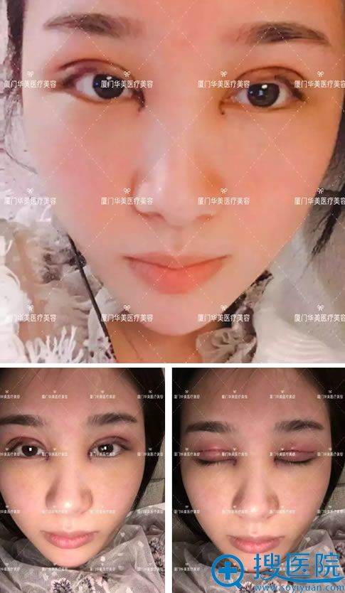 华美陈运生双眼皮案例即刻效果 华美陈运生双眼皮案例即刻效果
