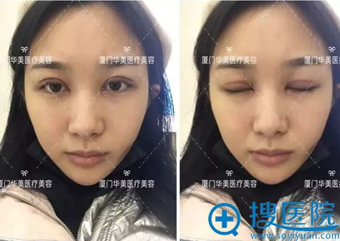 厦门华美做双眼皮7天恢复照 厦门华美做双眼皮7天恢复照