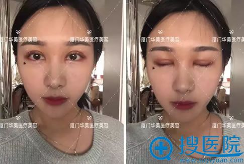 做双眼皮手术16天恢复效果图 做双眼皮手术16天恢复效果图