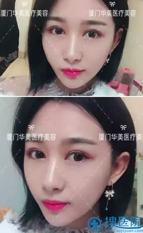 选择厦门华美陈运生做双眼皮第35天 选择厦门华美陈运生做双眼皮第35天