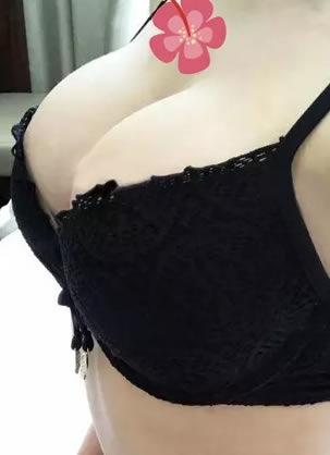 我成功的假体隆胸过程 沈阳金皇后杨成主任隆胸技术真的很赞