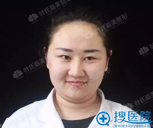 线雕提升前的双下巴 线雕提升前的双下巴