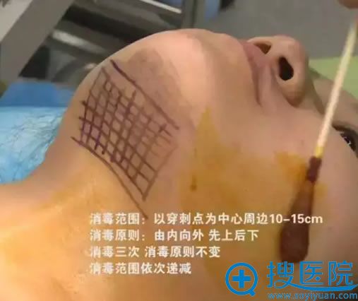 下巴线雕提升术前消毒工作 下巴线雕提升术前消毒工作