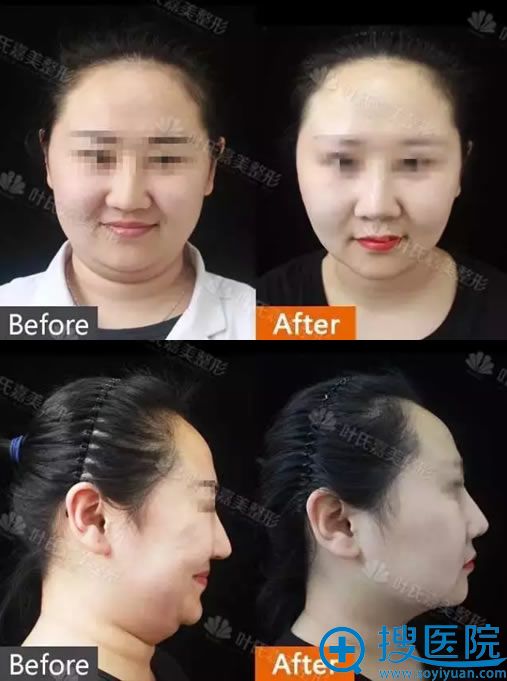 桂林星范线雕去双下巴手术即刻效果 桂林星范线雕去双下巴手术即刻效果