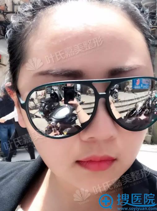 做完线雕去双下巴第3天恢复照 做完线雕去双下巴第3天恢复照