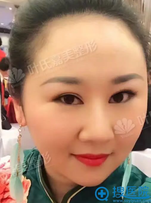 做完下巴线雕手术15天效果图 做完下巴线雕手术15天效果图