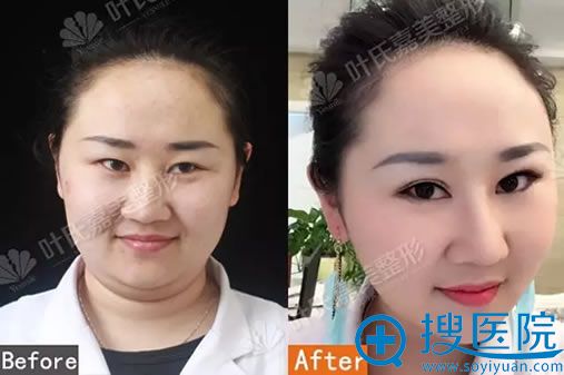 桂林星范线雕案例1个月对比图 桂林星范线雕案例1个月对比图