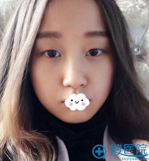 <!--<i data=20240710 data-id=12091></i>-->整形美容医院双眼皮案例 <!--<i data=20240710 data-id=12091></i>-->整形美容医院双眼皮案例