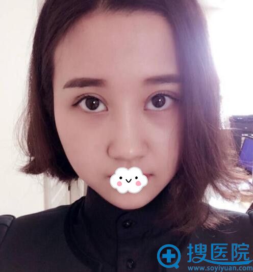 <!--<i data=20240710 data-id=12091></i>-->整形医院王娟双眼皮+开眼角效果 <!--<i data=20240710 data-id=12091></i>-->整形医院王娟双眼皮+开眼角效果