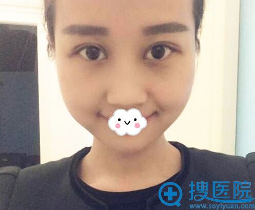 <!--<i data=20240710 data-id=12091></i>-->整形美容医院王娟双眼皮案例 <!--<i data=20240710 data-id=12091></i>-->整形美容医院王娟双眼皮案例