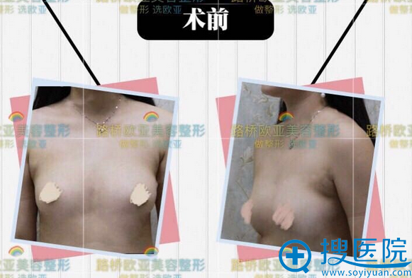 我的胸就从荷包蛋变D罩杯就是因为在台州欧亚做了假体丰胸