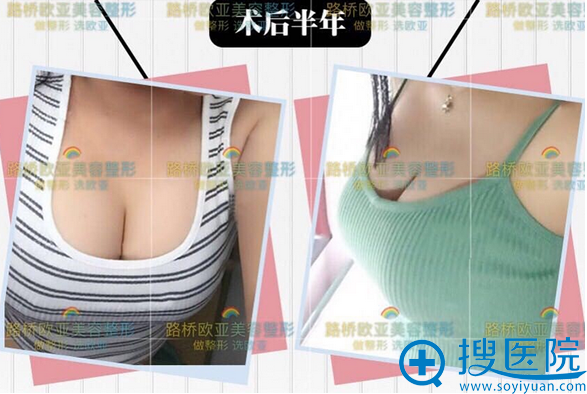 台州欧亚整形假体丰胸案例 台州欧亚整形假体丰胸案例