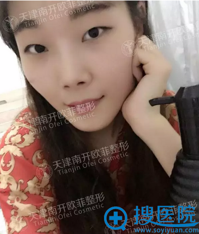 找天津欧菲整形医院闫腾元做完Park双眼皮加开内眼角后自信多了