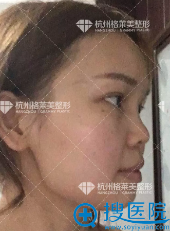 塌鼻三姐妹相约找杭州格莱美张龙和张树平做了自体肋软骨隆鼻
