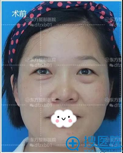 郑州东方员工亲测做完祛眼袋+双眼皮后效果看案例简直相差20岁