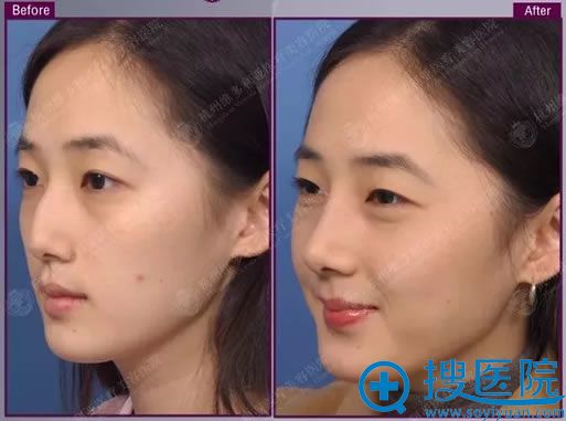 杭州维多利亚欧颜公主鼻综合案例 杭州维多利亚欧颜公主鼻综合案例