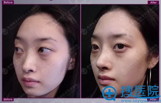 维多利亚欧颜公主鼻真人案例 维多利亚欧颜公主鼻真人案例