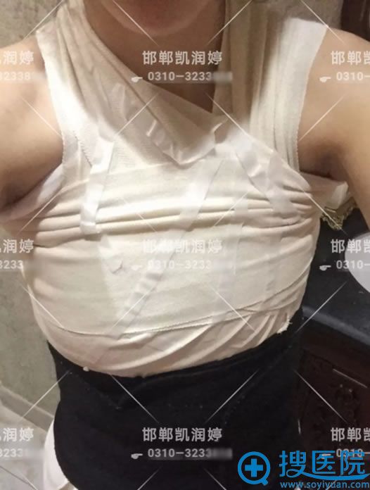<!--<i data=20240710 data-id=12092></i>-->假体隆胸手术1天效果 <!--<i data=20240710 data-id=12092></i>-->假体隆胸手术1天效果