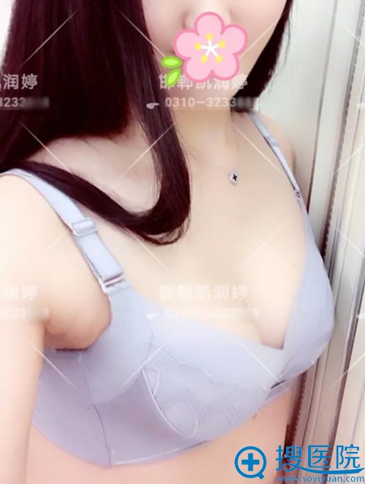 选择<!--<i data=20240710 data-id=12142></i>-->假体隆胸3个月恢复效果 选择<!--<i data=20240710 data-id=12142></i>-->假体隆胸3个月恢复效果