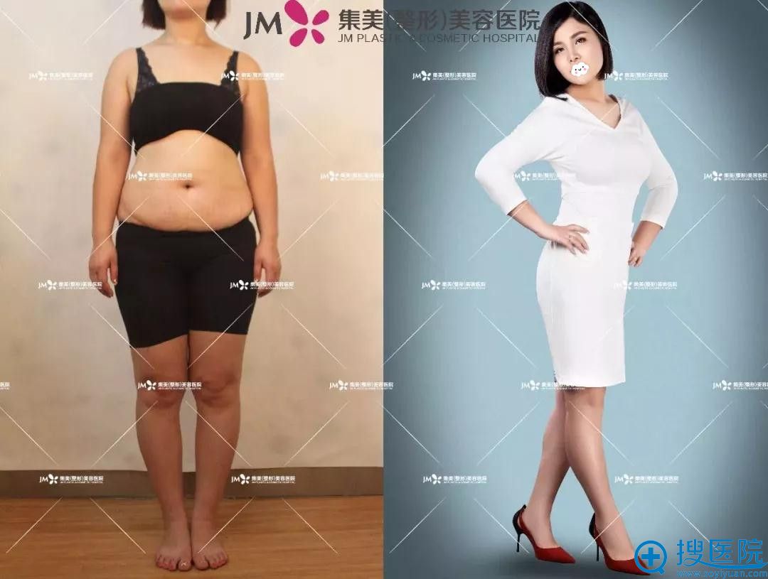 郑州集美美容医院腰腹吸脂案例 郑州集美美容医院腰腹吸脂案例