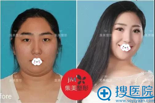 郑州集美美容医院面部吸脂案例 郑州集美美容医院面部吸脂案例
