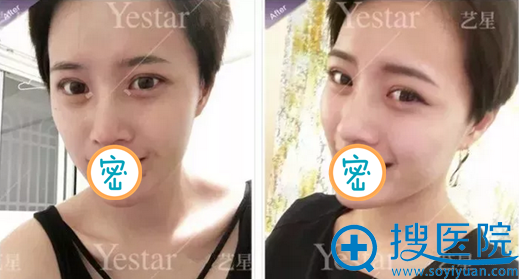 武汉艺星美杜莎综合美眼术后7天照片 武汉艺星美杜莎综合美眼术后7天照片