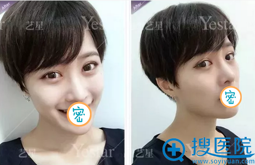 武汉yestar美杜莎美眼+宫廷隆鼻半个月恢复照 武汉yestar美杜莎美眼+宫廷隆鼻半个月恢复照
