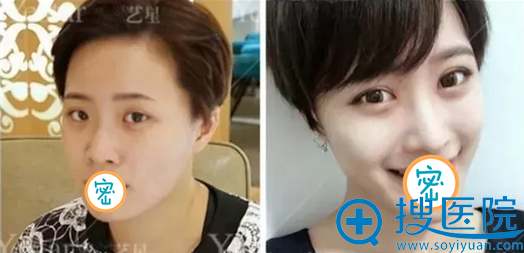美杜莎双眼皮+宫廷隆鼻术前术后对比 美杜莎双眼皮+宫廷隆鼻术前术后对比