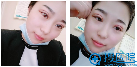苏州紫馨<!--<i data=20240710 data-id=16495></i>-->医生切开双眼皮案例图 苏州紫馨<!--<i data=20240710 data-id=16495></i>-->医生切开双眼皮案例图