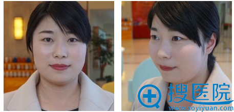 不得不感慨苏州紫馨医疗美容医院孙军做的双眼皮也太好看了吧