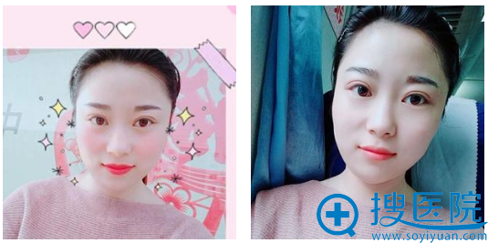 苏州紫馨<!--<i data=20240710 data-id=16495></i>-->做双眼皮怎么样,看半个月效果图 苏州紫馨<!--<i data=20240710 data-id=16495></i>-->做双眼皮怎么样,看半个月效果图
