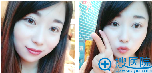 不知不觉找苏州紫馨<!--<i data=20240710 data-id=16495></i>-->做双眼皮一个月了 不知不觉找苏州紫馨<!--<i data=20240710 data-id=16495></i>-->做双眼皮一个月了