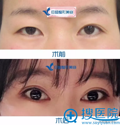 <!--<i data=20240710 data-id=9063></i>-->整形美容医院大吴医生双眼皮案例 <!--<i data=20240710 data-id=9063></i>-->整形美容医院大吴医生双眼皮案例