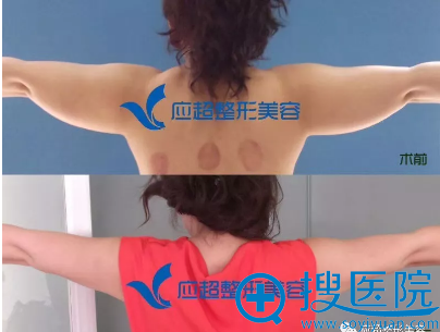 <!--<i data=20240710 data-id=9079></i>-->整形医院吴化勇(小吴医生)上臂抽脂案例图 <!--<i data=20240710 data-id=9079></i>-->整形医院吴化勇(小吴医生)上臂抽脂案例图