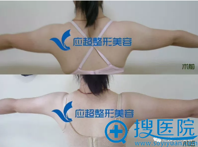 <!--<i data=20240710 data-id=9079></i>-->整形医院吴化勇(小吴医生)手臂吸脂案例 <!--<i data=20240710 data-id=9079></i>-->整形医院吴化勇(小吴医生)手臂吸脂案例