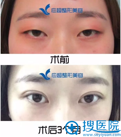 <!--<i data=20240710 data-id=9079></i>-->整形医院吴光宇双眼皮案例 <!--<i data=20240710 data-id=9079></i>-->整形医院吴光宇双眼皮案例
