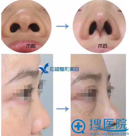 <!--<i data=20240710 data-id=9079></i>-->整形医院李作勇医生隆鼻案例 <!--<i data=20240710 data-id=9079></i>-->整形医院李作勇医生隆鼻案例