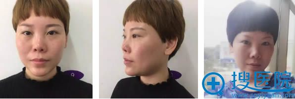 我比较了合肥韩美和华美的整形价格后,较后去韩美做了综合隆鼻
