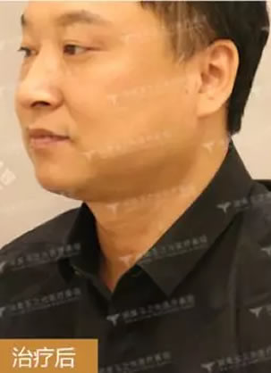 商务男士颈纹泛滥 润美玉之光宋秋丽PDH中胚层助其成功去颈纹