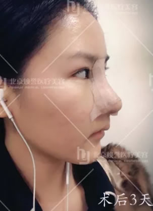 看了北京焕誉令人心动的隆鼻案例效果 确定选择王征做了鼻综合