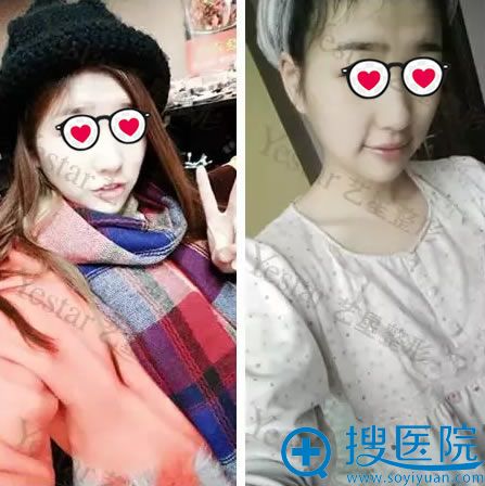 选择北京艺星做自体脂肪填充前 选择北京艺星做自体脂肪填充前